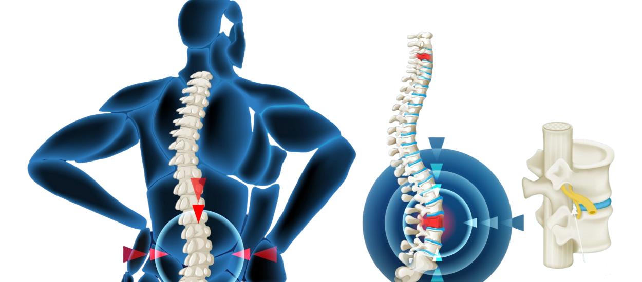 Hernia de disc nu trebuie operată întotdeauna. Când este necesară intervenția, explică neurochirurgul Ștefan Suditu