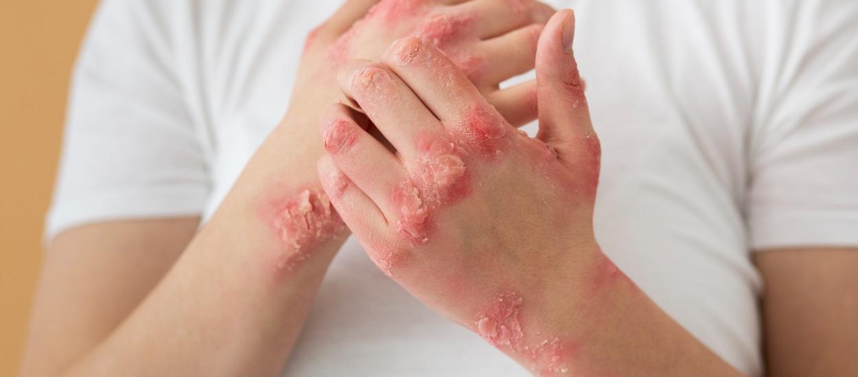 Psoriazisul, mai complicat decât pare. Ce s-a descoperit în urma noilor cercetări