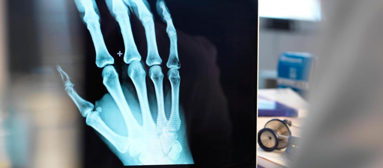 Tratament experimental pentru osteoporoză testat pentru prima dată pe oameni