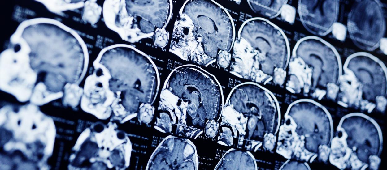 Ce au descoperit cercetătorii despre cel mai agresiv cancer cerebral