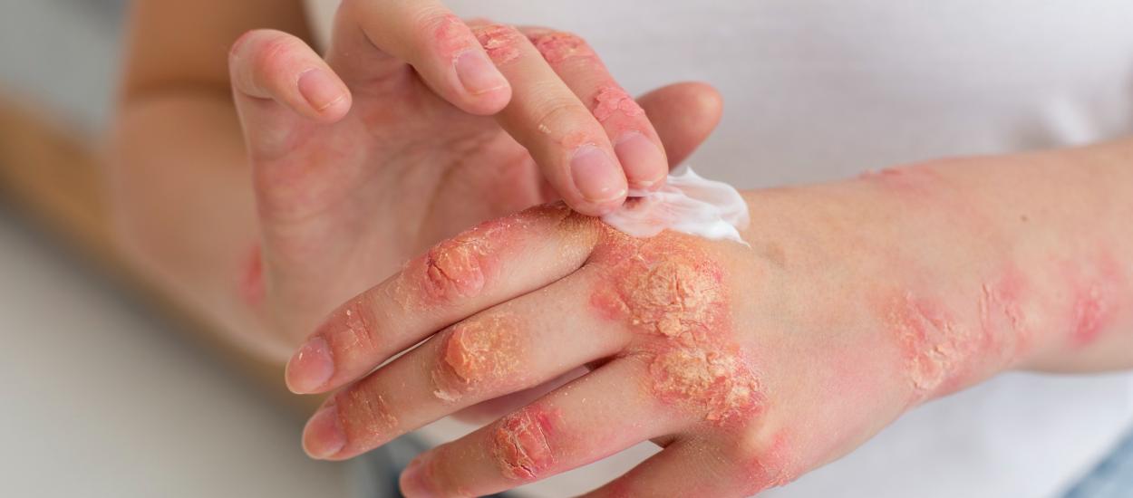 Psoriazisul cu pustule nu afectează doar pielea: risc mai mare de boli grave și mortalitate