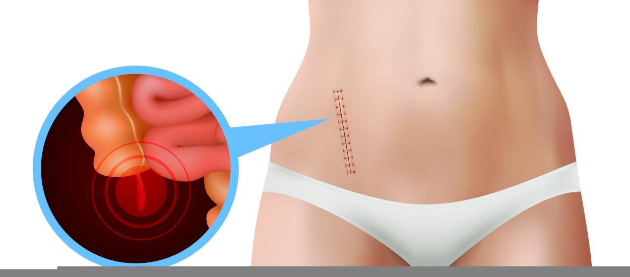 Operația de apendicită este asociată cu un risc de cancer colorectal cu 58% mai mic decât tratamentul