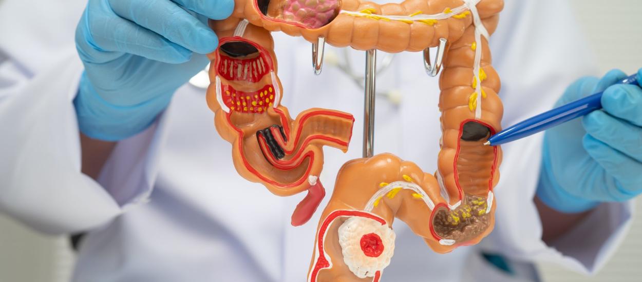 Cum reducem riscul de cancer colorectal. Recomandările unui medic gastroenterolog