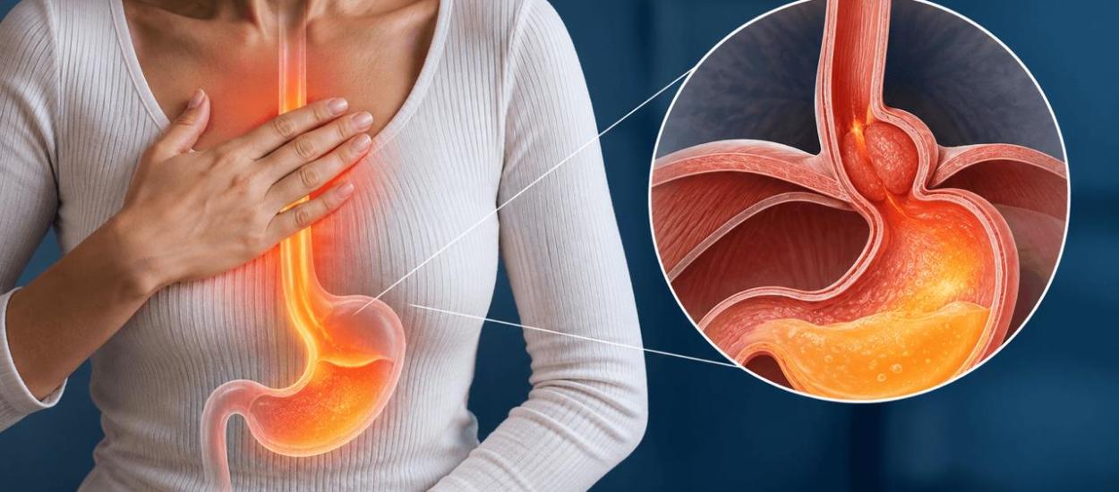 Hernia hiatală: când arsurile din piept pot fi tratate medicamentos și când chirurgia devine o opțiune 