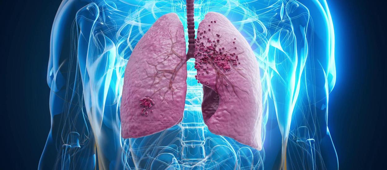 Ce este mai exact un nodul pulmonar și care este legătura cu cancerul? Cazul Papei Leon