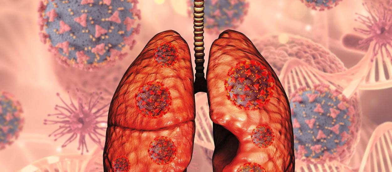 Nodulii pulmonari: când pot indica un cancer pulmonar și cine are nevoie de investigații. Conf. univ. dr. Beatrice Mahler explică