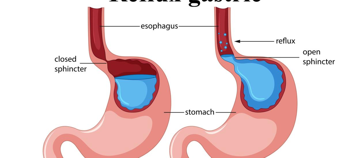 Remediul cu oțet care ar putea ajuta cu refluxul gastric. Atenție însă, uneori poate agrava simptomele