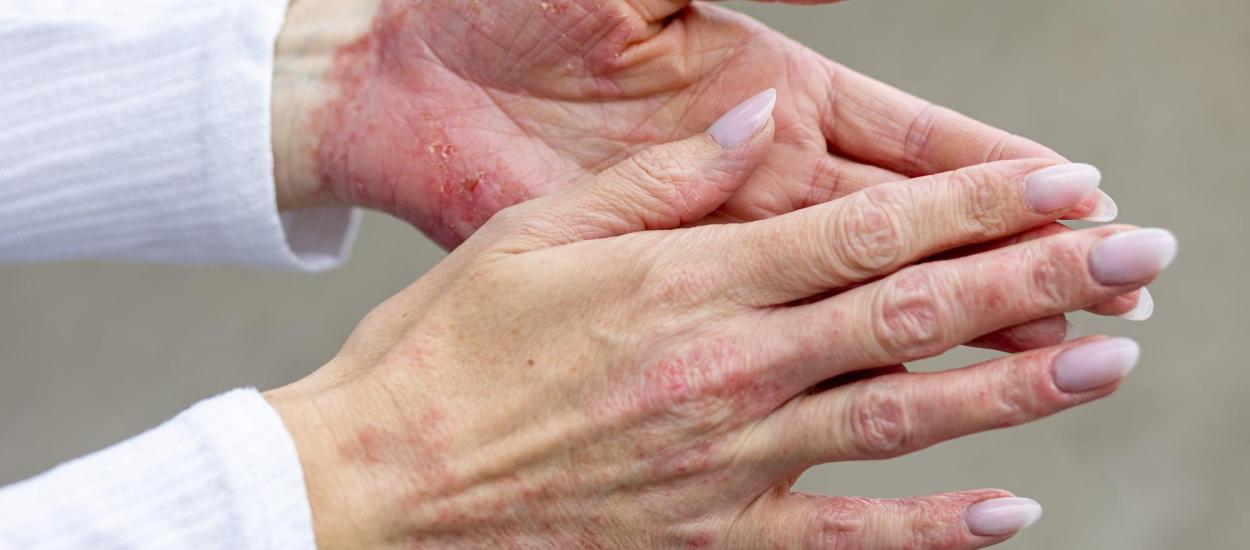 Psoriazisul ar putea fi combătut cu un supliment alimentar obișnuit