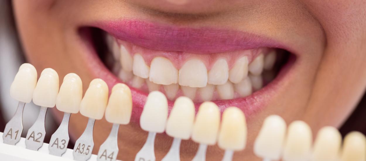 Pot avea fațete dentare fără șlefuirea dinților? Un stomatolog explică în ce cazuri este posibil