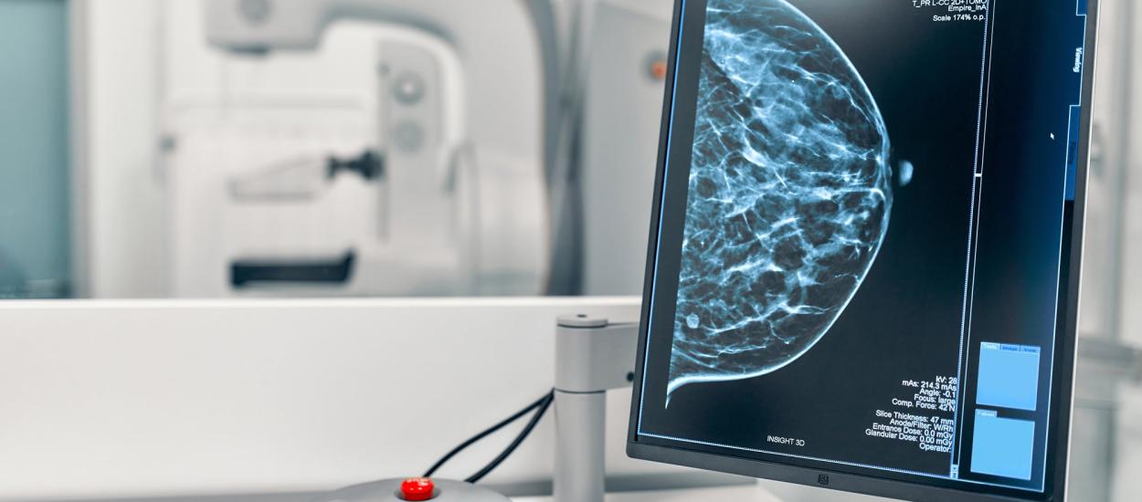 Testele de 2 minute care estimează riscul de cancer de sân. Dr. Ștefan Voiculescu (SANADOR): Boala poate apărea și fără antecedente familiale