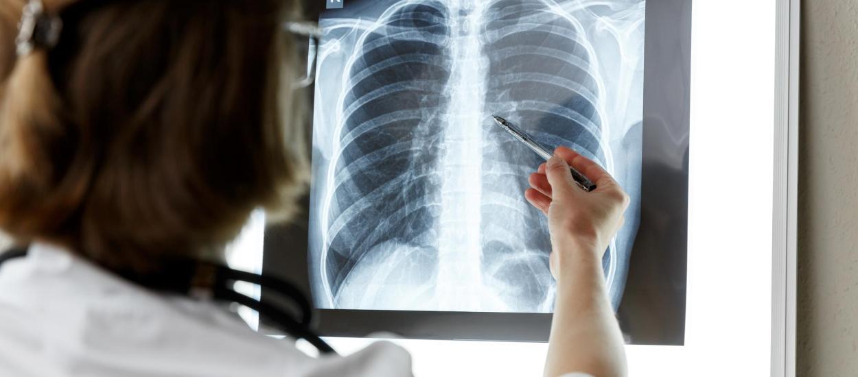 Cancer pulmonar la nefumători: factori de risc și simptome